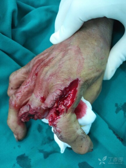 第二掌指关节破坏,示指远端移位再植 虎口成形. [病例帖]