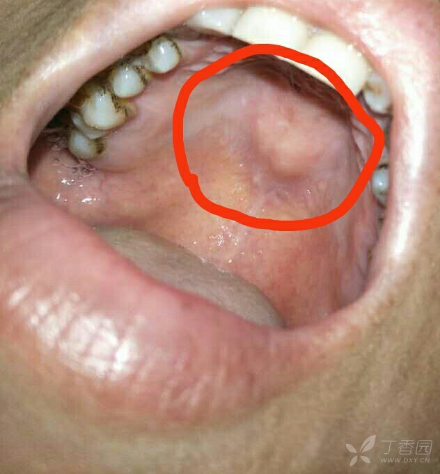 口腔上颚肉瘤图图片
