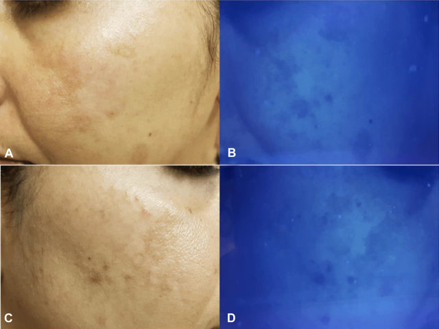 Subclinical melasma.jpg