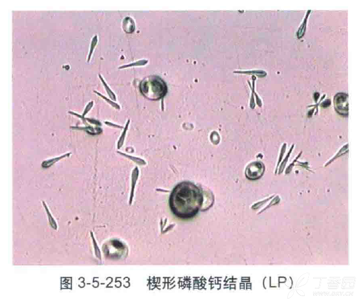 尿磷酸钙结晶图片