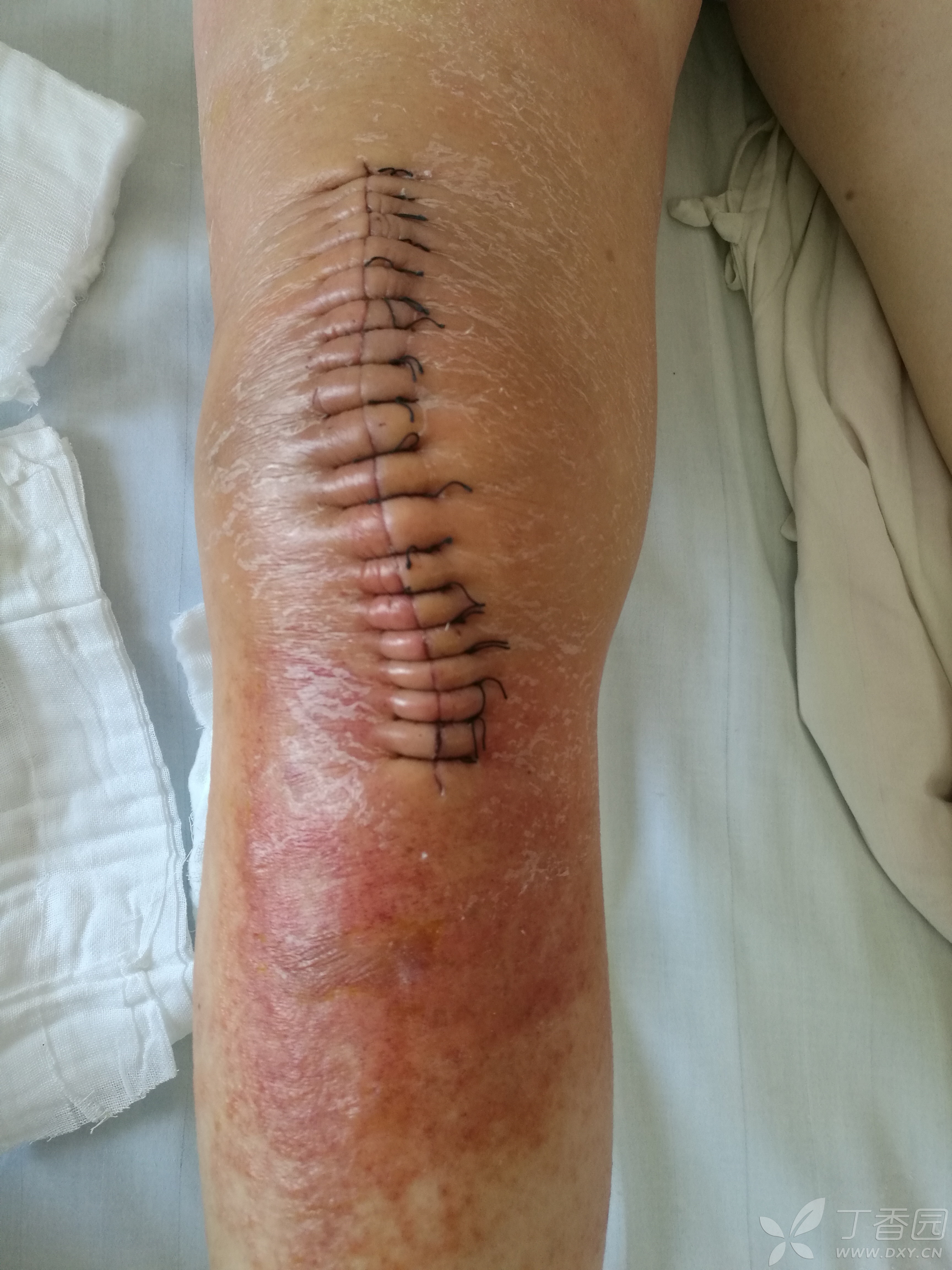 膝关节置换术后伤口周边红肿,求各位大神指导 [病例帖]