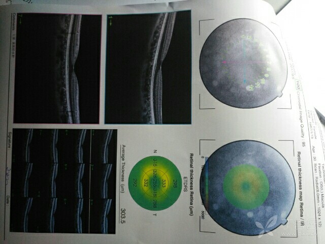 眼前阴影,请大家分析一下这是什么原因?