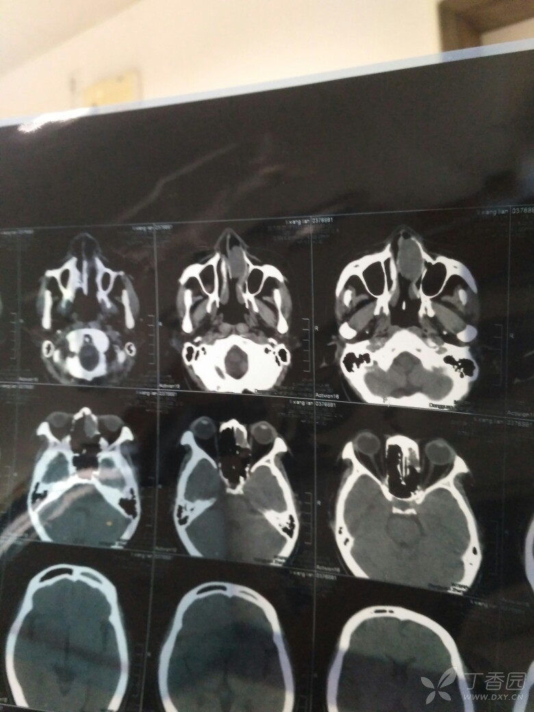左侧额窦,前组筛窦炎!做病检为结节性筋膜炎,患者例假来了,没能手术!