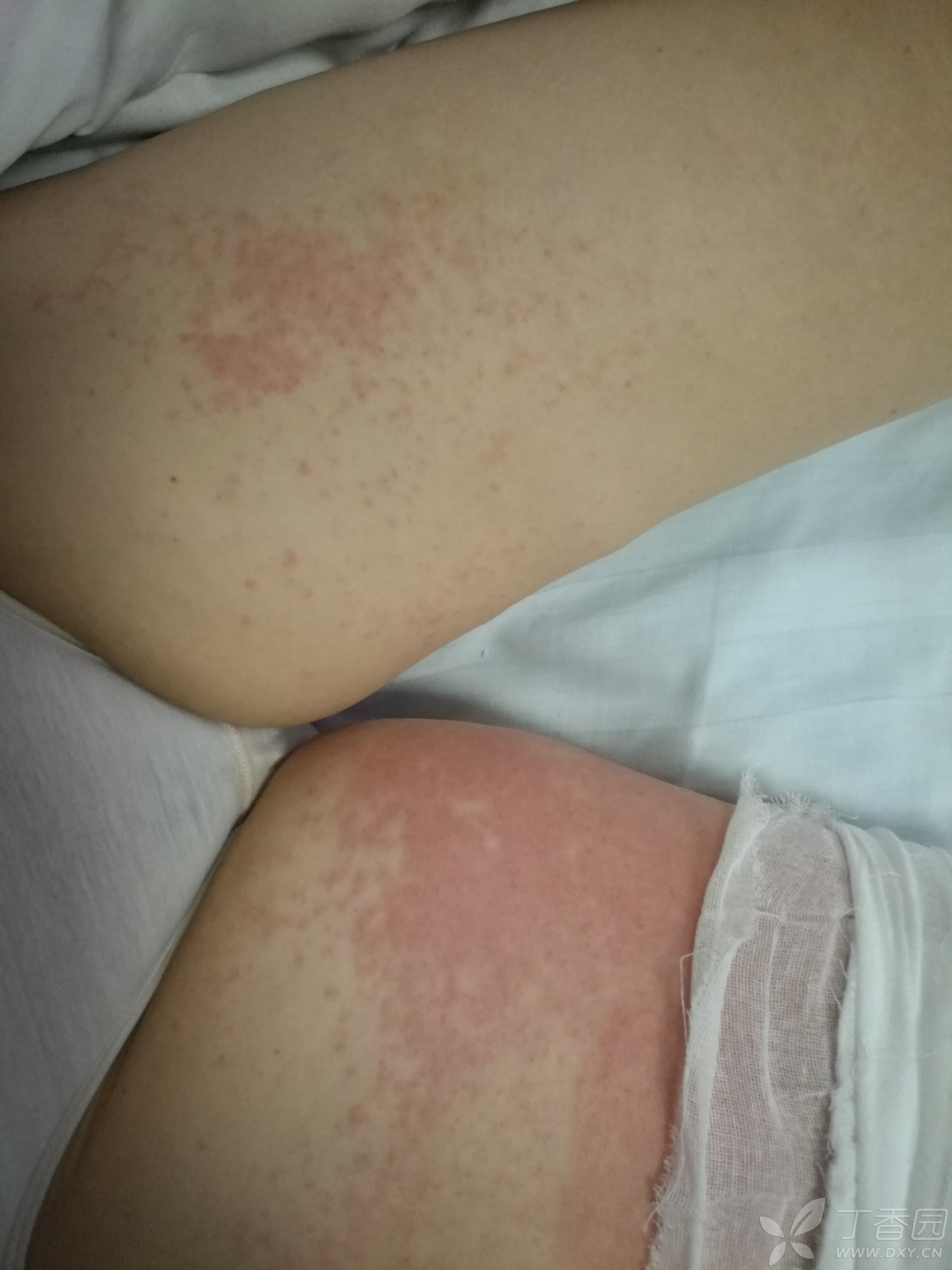 膝关节置换术后伤口周边红肿,求各位大神指导 [病例帖]