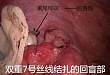 腹腔镜下阑尾根部穿孔处理经验分享（图文+视频）