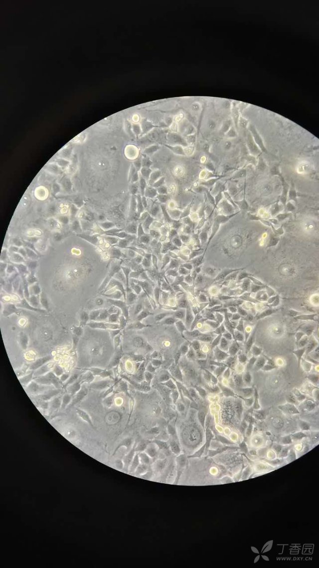 dxy_ouujn1y4  mda-mb-231这株细胞在传代扩增很多次之后,感觉镜下