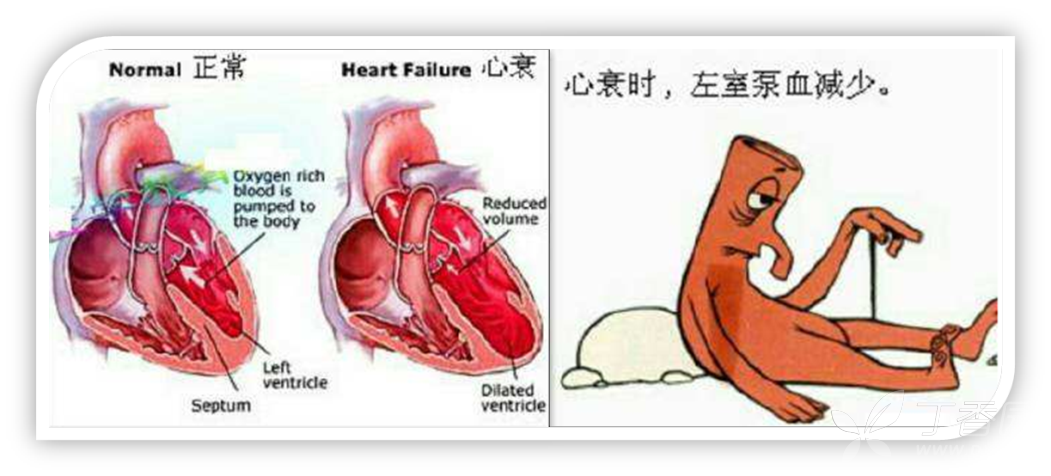 心力衰竭都是以左心衰竭開始的,即首先表現為肺循環淤血.