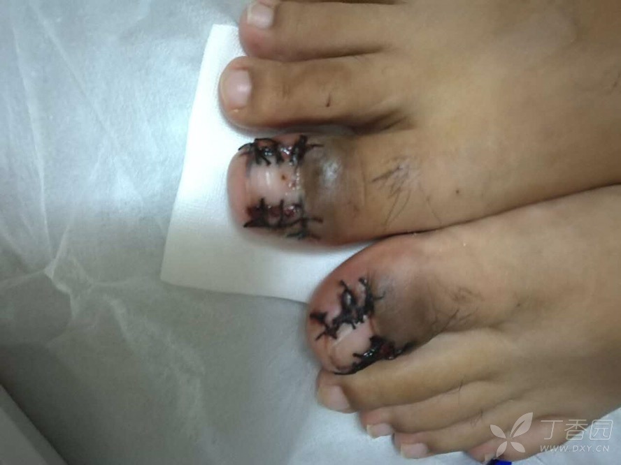 双足踇趾嵌甲甲沟炎治疗(患者是亲属) [病例帖]