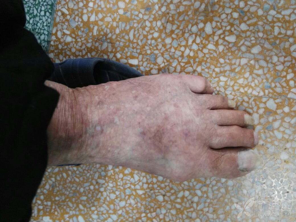 痛风病人痛风石表现照片: [病例帖]