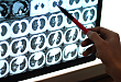 肺炎的 CT 读片解析