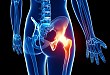 股骨粗隆间骨折的分型与治疗