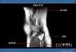 精彩幻灯：膝关节正常MRI