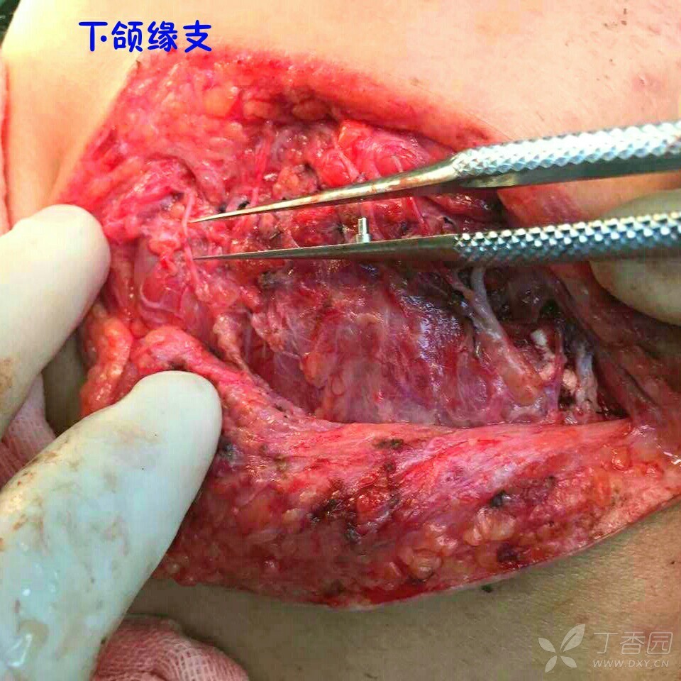 唾液腺导管堵塞图片