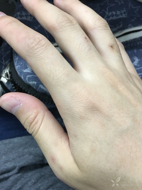 双手多发性红色结节 [病例帖]