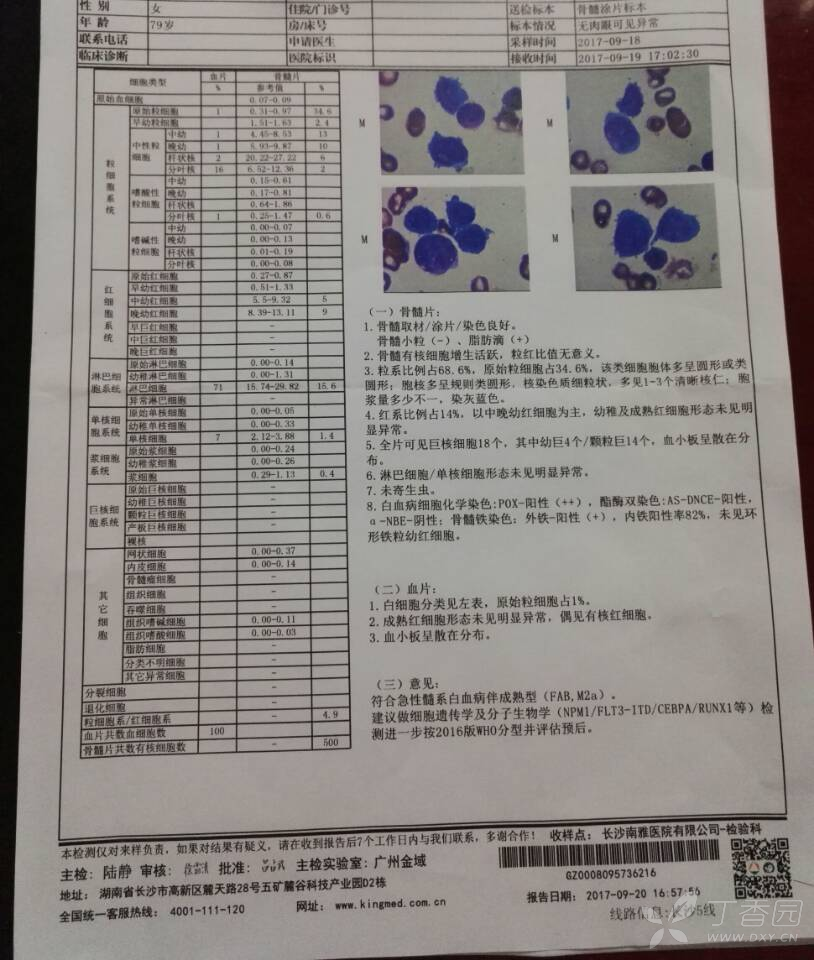 急性髓系白血病伴成熟型