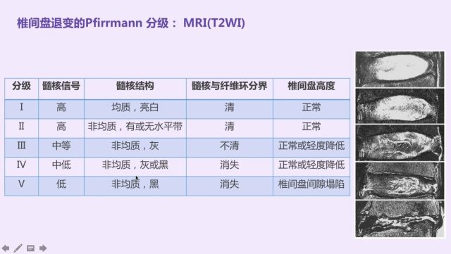 椎间盘退变的 pfirrmann 分级