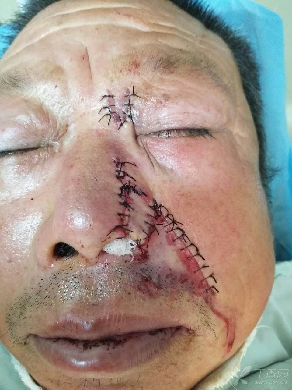 【讨论】鼻翼部分缺损