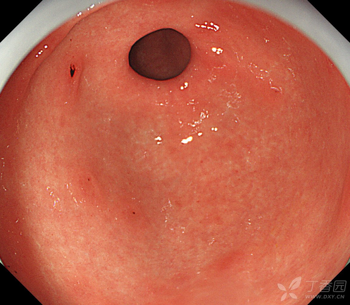 正常胃粘膜镜下表现图片