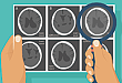 10 分钟掌握脑梗死的 CT 影像