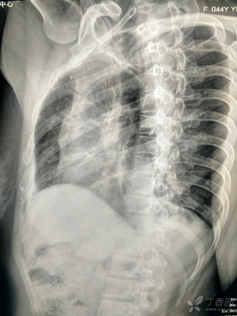 肋骨骨折还是投影折影 影像核医学 丁香园论坛