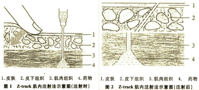 z型肌肉注射法图片