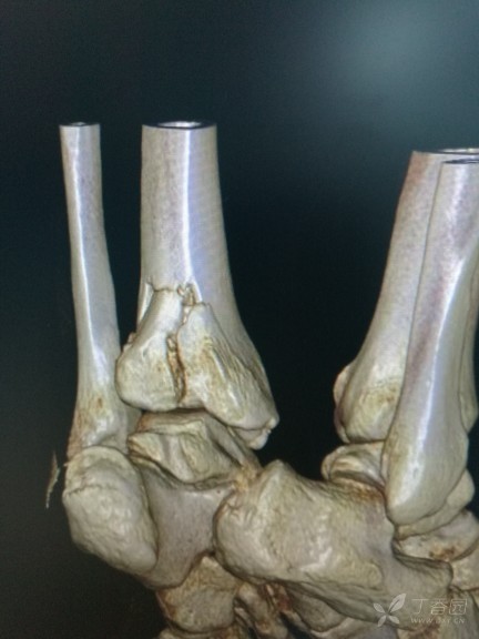 后踝骨折手术复位求教