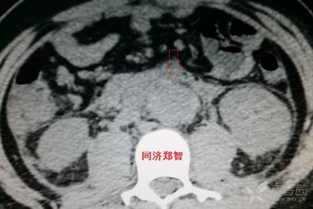 主动脉夹层a型是升主动脉吗 3236985801079831391-8w.jpeg
