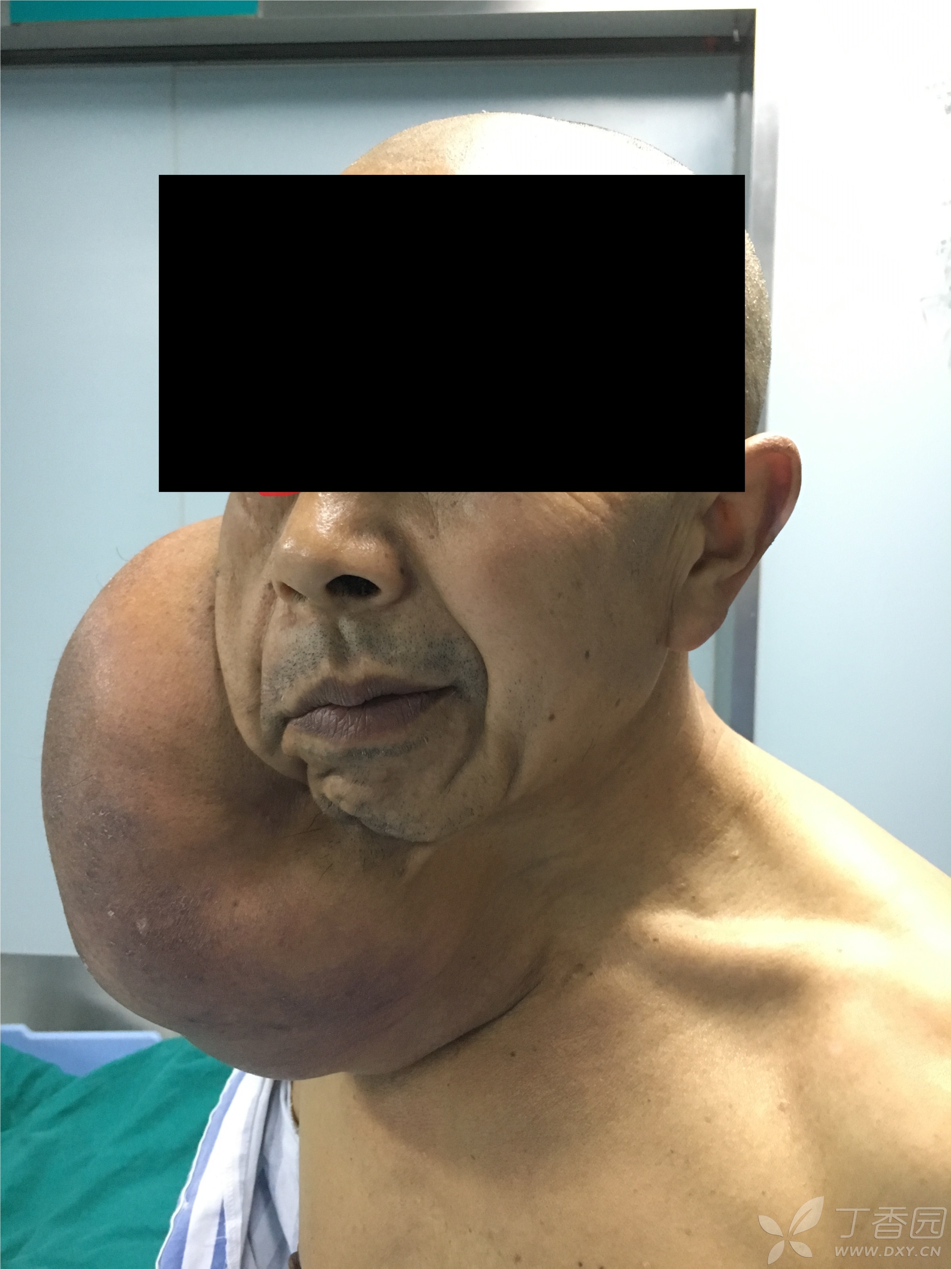 脖子上长脂肪瘤图片图片