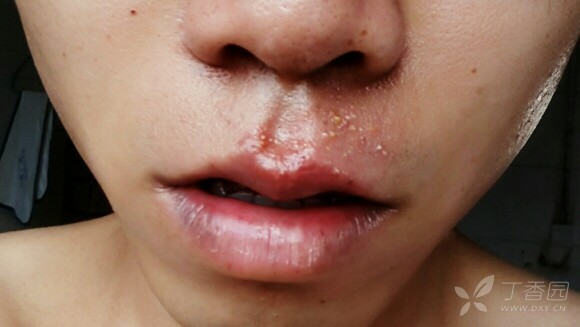 口唇周围疱疹,皮肤科老师考虑复发性单纯疱疹,但是阿昔洛韦,伐昔洛伟