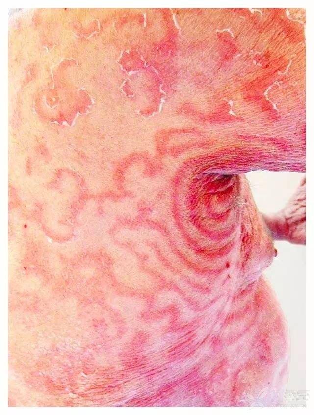 今日病例挑战 这种皮肤症状你见过么 猜猜是什么病 肿瘤医学讨论版 丁香园论坛