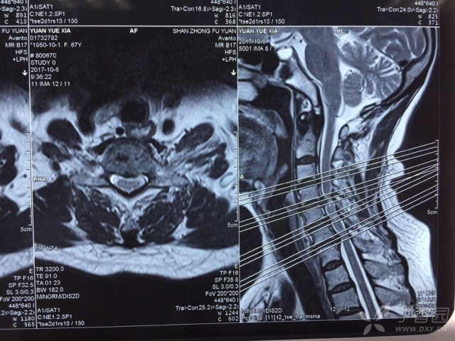 一例多阶段脊髓型颈椎病,大家看看