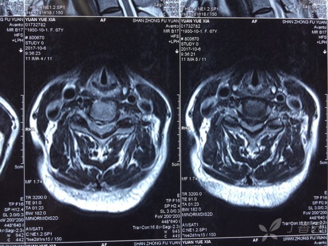 一例多阶段脊髓型颈椎病,大家看看