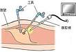 手术直播室：肾盂输尿管癌根治术也能用腹腔镜？