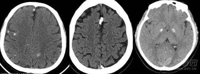 甲状腺结节良恶性5标准 图解：颅内出现这 7 个部位的钙化属正常