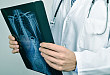 AOspine 胸腰椎损伤新分类系统