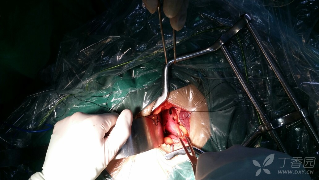 罕见的十二指肠球部双溃疡穿孔 [病例帖]