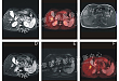 PET / MR 检查肝右叶肝癌