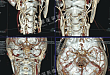 FLASH 双源 CT 检查动脉血管狭窄
