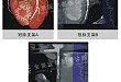 FLASH 双源 CT 检查，评估支架植入后的疗效