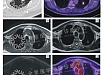 PET / MR检查周围型肺癌