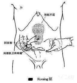 rovsing征图片