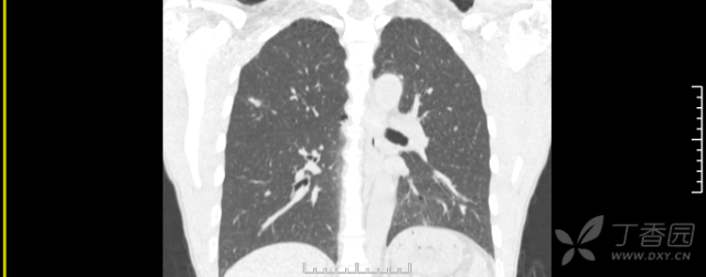 右肺上叶结节,患者已手术,有病理【病理结果已