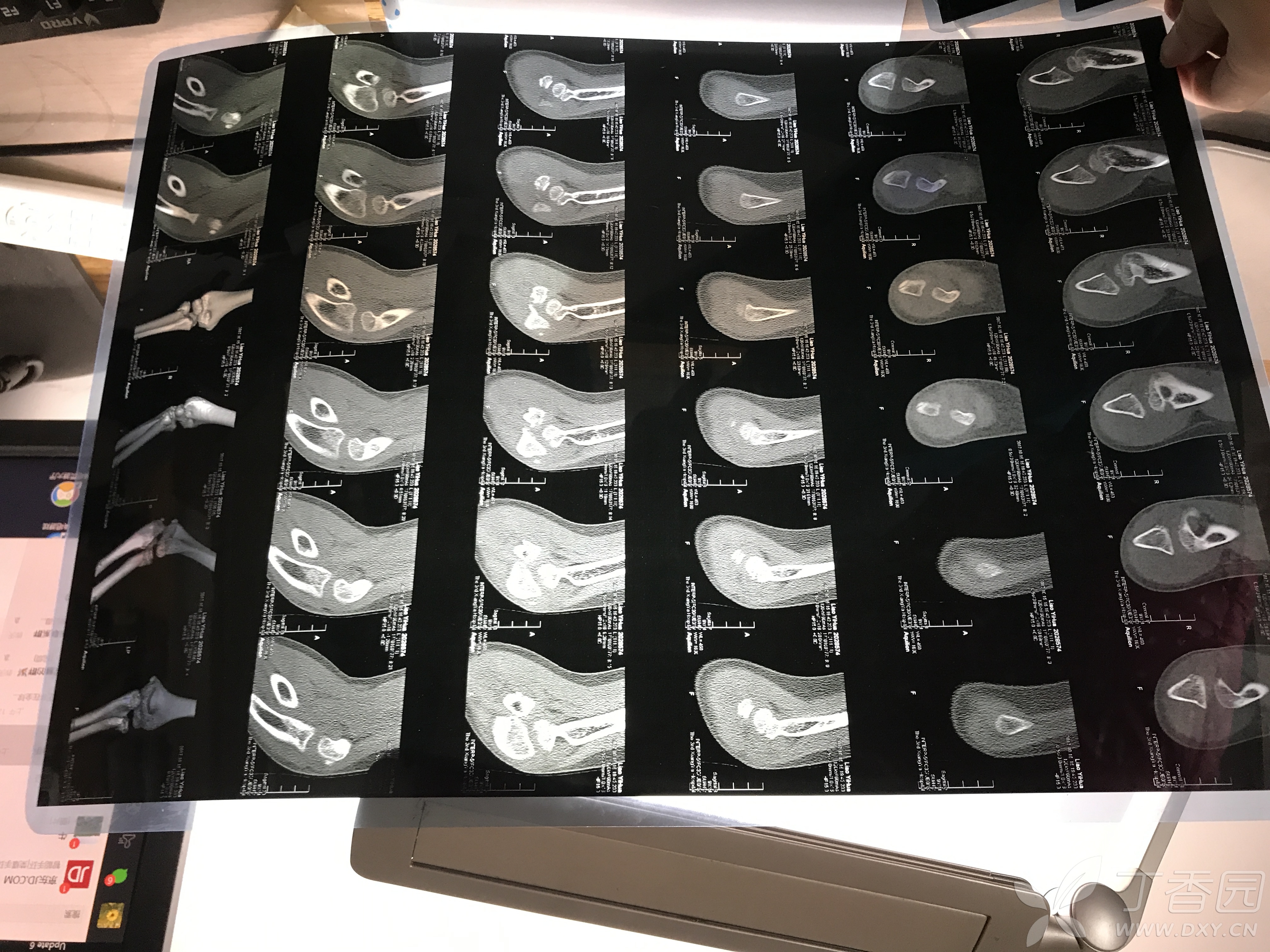 9岁男孩桡骨近端骨折,断端错位治疗方案求助-保守治疗or手术治疗