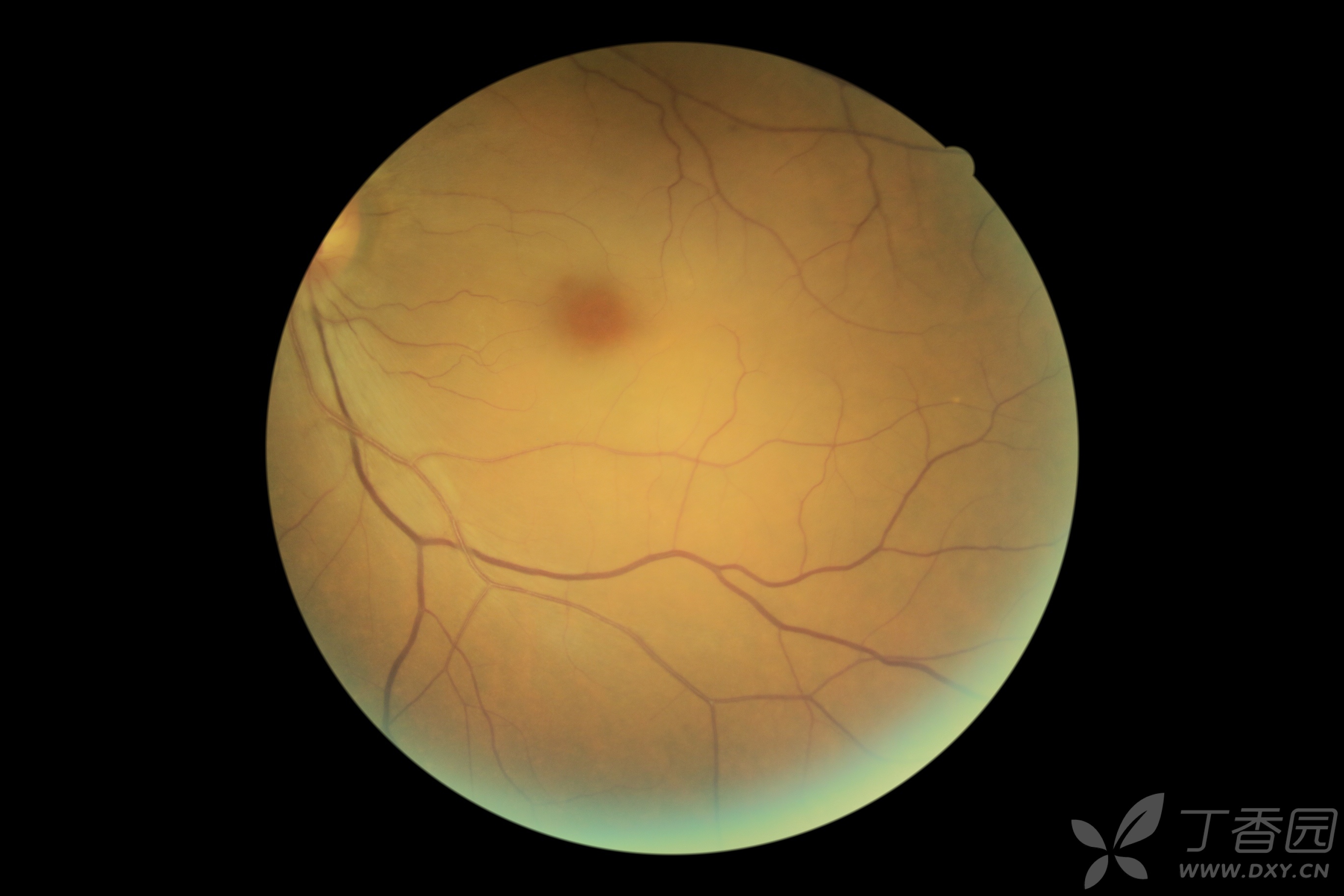 发一组近期拍的眼底照片,与初学者共赏.