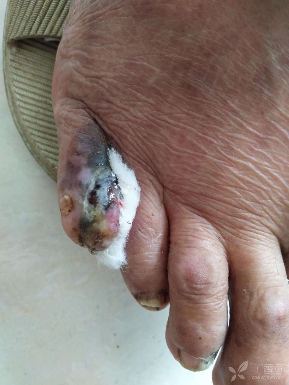 请大家指导这例足趾坏死的治疗(有后续)有什么错误吗 [病例帖]