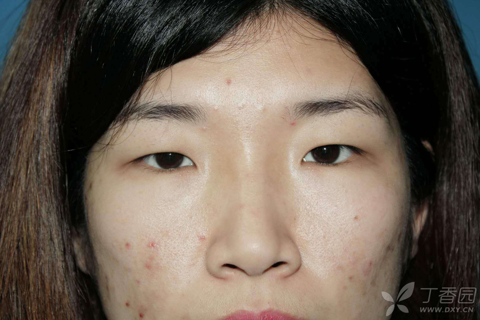 【讨论】假性眼睑下垂重睑术 [病例帖]