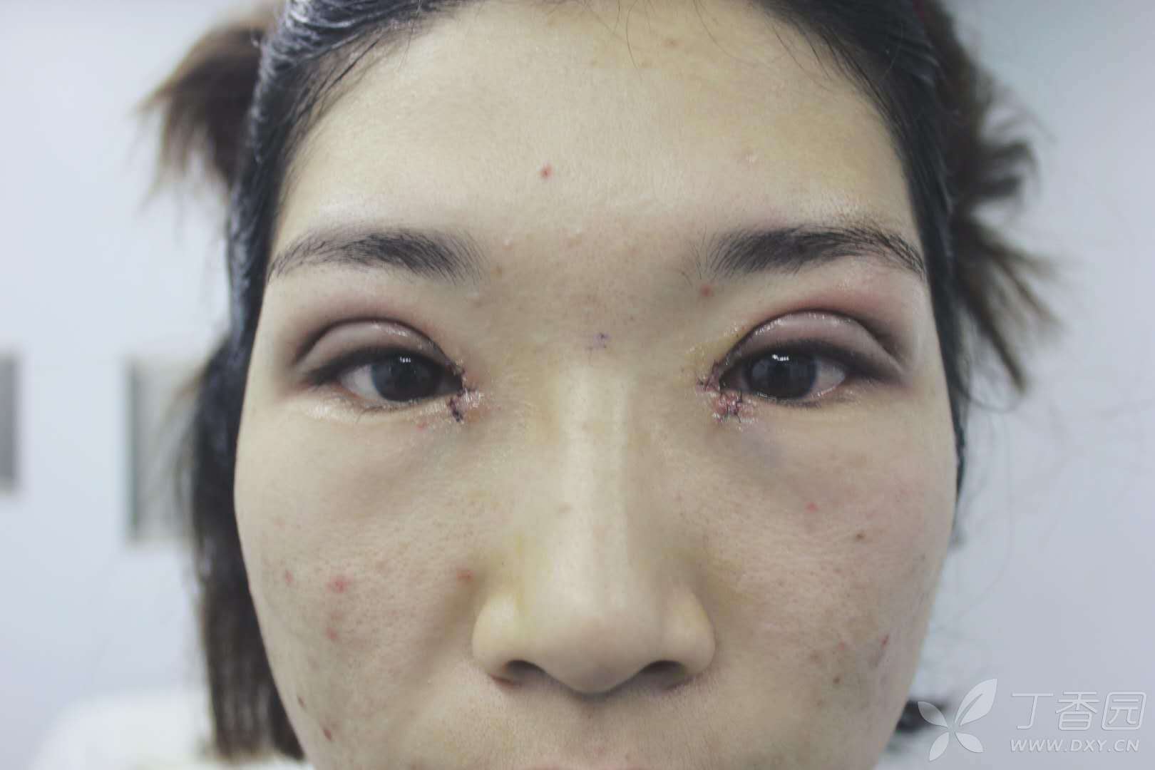【讨论】假性眼睑下垂重睑术 [病例帖]