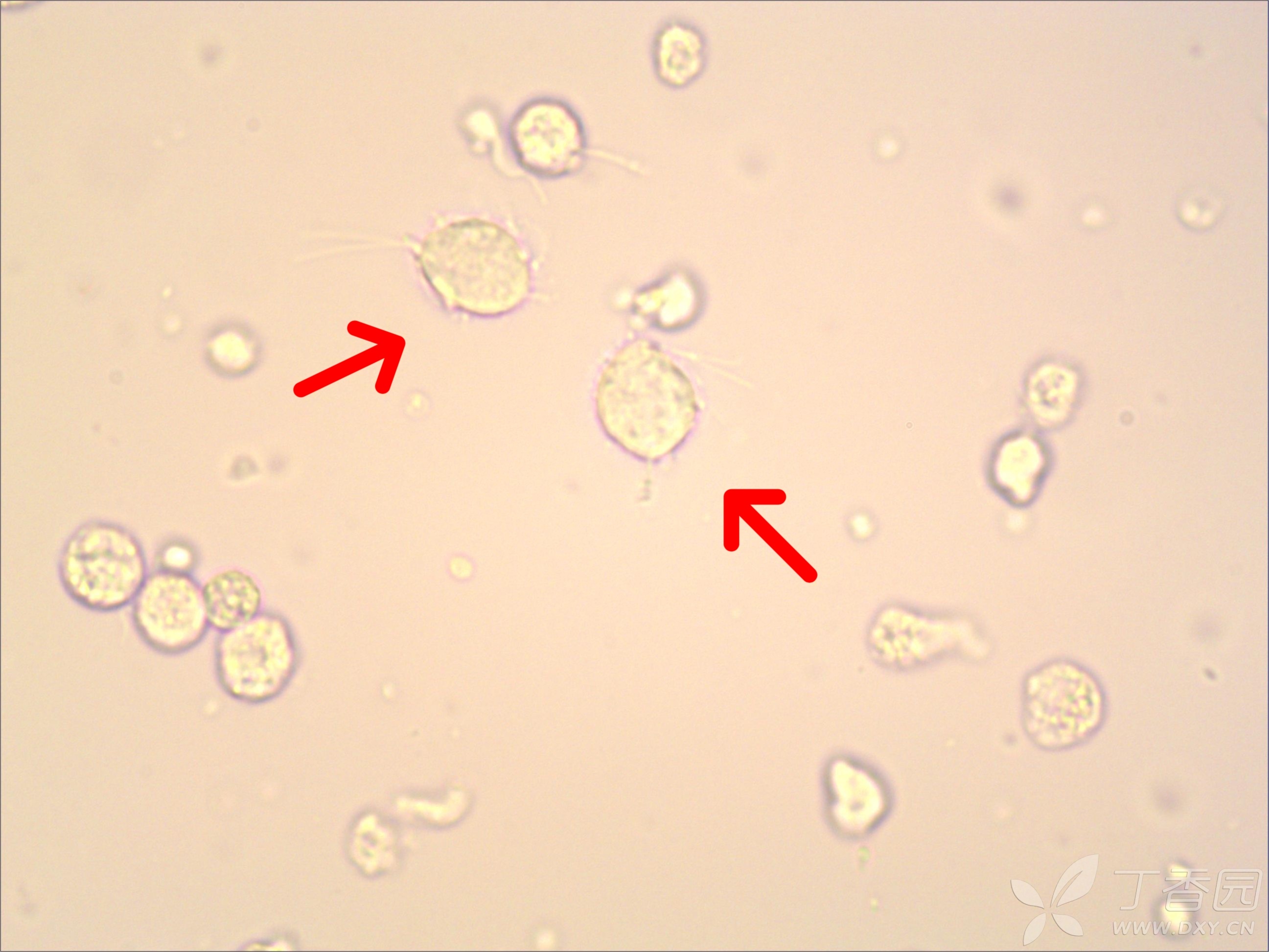 美图分享3——滴虫和真菌（尿液标本） - 临床检验医学讨论版 -丁香园论坛