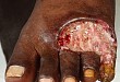 JAMA Dermatol 病例挑战：小腿不愈性溃疡