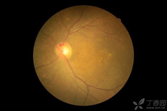 什么是黄斑病变 3240023109341316676-8w.jpg!w640